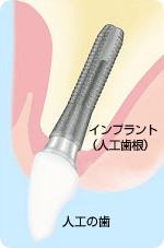 インプラント治療とは
