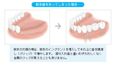 数本歯を失ってしまった場合